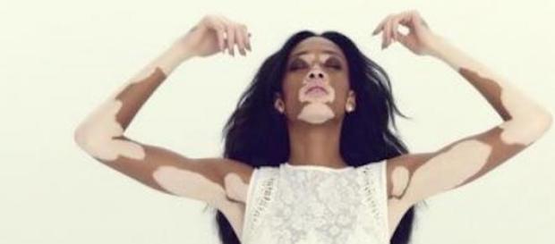 Winnie Harlow a fait du vitiligo sa particularité. Winnie Harlow a fait du vitiligo sa particularité.