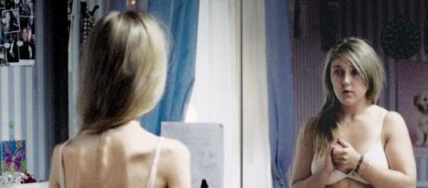 Anorexia, un caso extremo de delgadez Anorexia, un caso extremo de delgadez