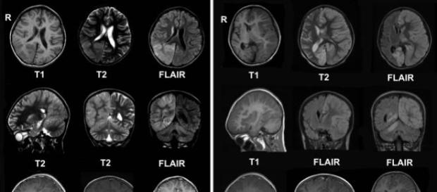 La epilepsia afecta el cerebro de la persona La epilepsia afecta el cerebro de la persona