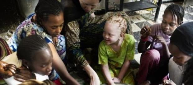 Les enfants albinos sont victimes d'attaques. Les enfants albinos sont victimes d'attaques.