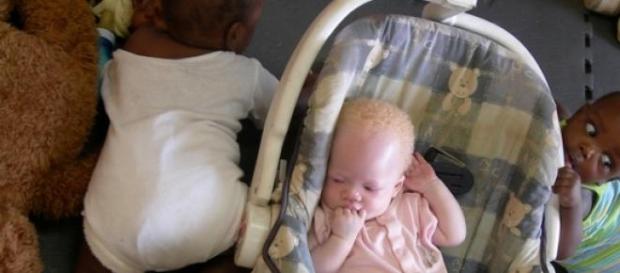 Albino-Baby in Waisenhaus. Albino-Baby in Waisenhaus.