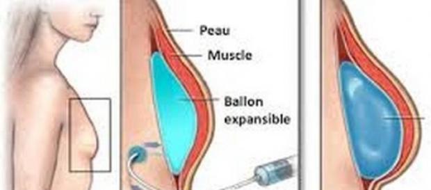 schéma de chirurgie des seins schéma de chirurgie des seins