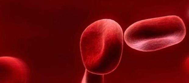 La anemia por falta de hierro es muy común La anemia por falta de hierro es muy común