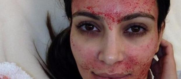 The Vampire Facial that's sucking A-lister blood The Vampire Facial that's sucking A-lister blood