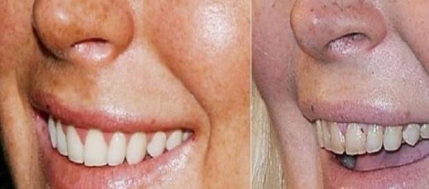 Rotina que vai destruindo os dentes. Rotina que vai destruindo os dentes.
