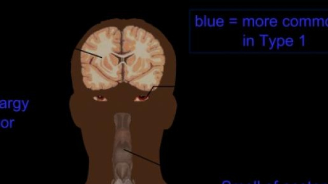 Cancro al seno e diabete: c'è una connessione