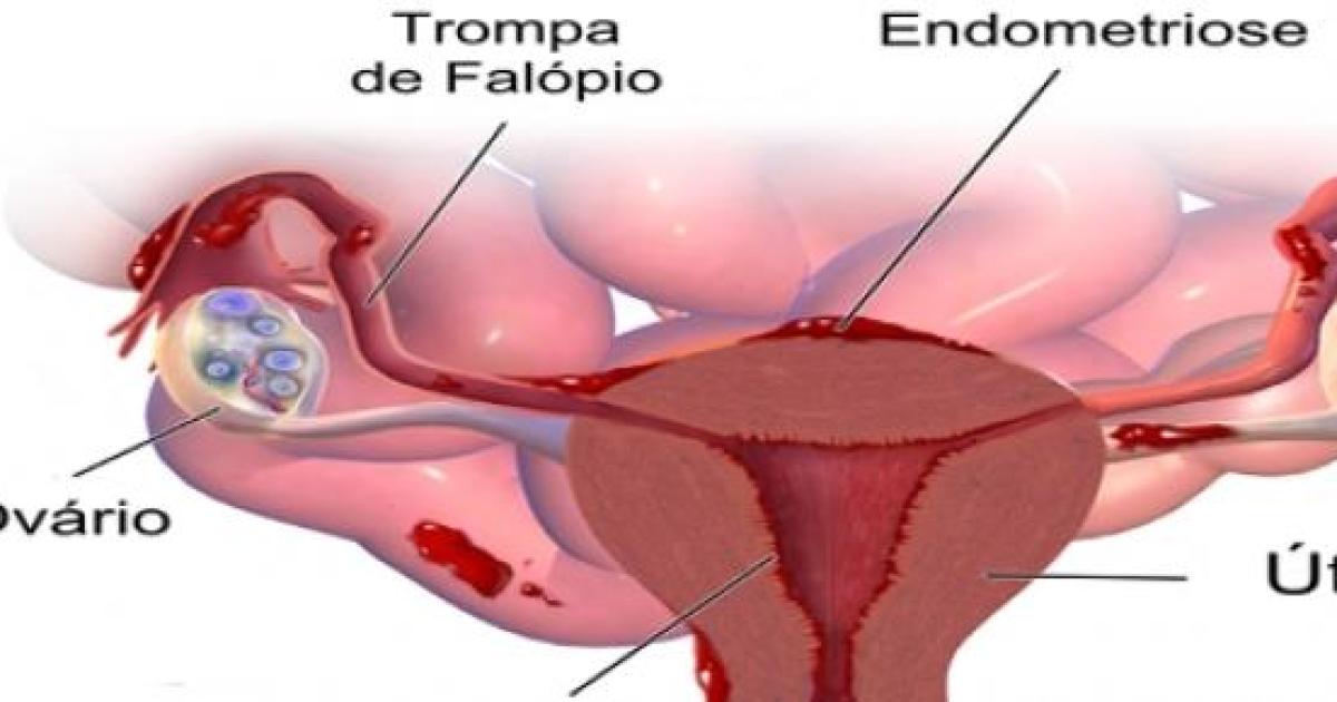 A Endometriose Do Endométrio Ao Tratamento 2150