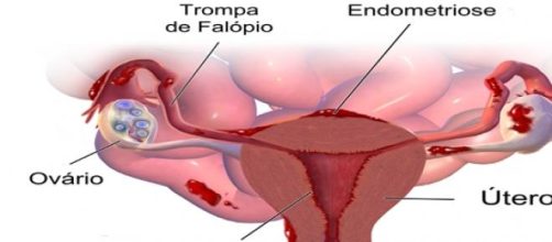 Endomentriose: distúrbio ginecológico.