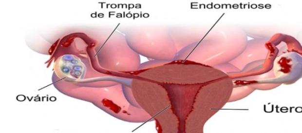 Endomentriose: distúrbio ginecológico. Endomentriose: distúrbio ginecológico.
