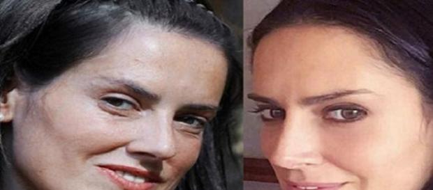 Adriana antes y después de la operación Adriana antes y después de la operación