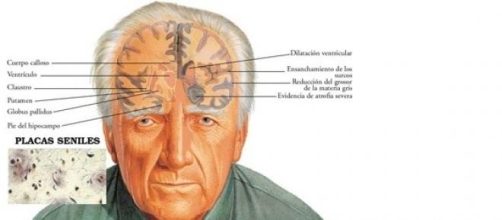 Psicopatologia del Morbo di Alzheimer.