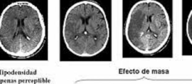 Las arterias obstruidas en ictus isquémico agudo. Las arterias obstruidas en ictus isquémico agudo.