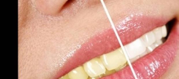 Clareamento de dentes também tem prescrição Clareamento de dentes também tem prescrição