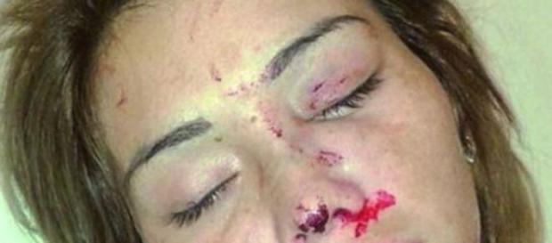 Assim ficou Rossi Recalde após as agressões Assim ficou Rossi Recalde após as agressões