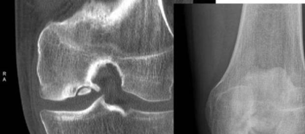 La osteoartritis afecta a las articulaciones La osteoartritis afecta a las articulaciones
