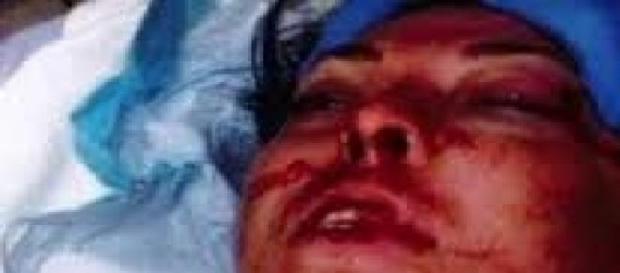 O tânără a fost desfigurată de polițiști O tânără a fost desfigurată de polițiști