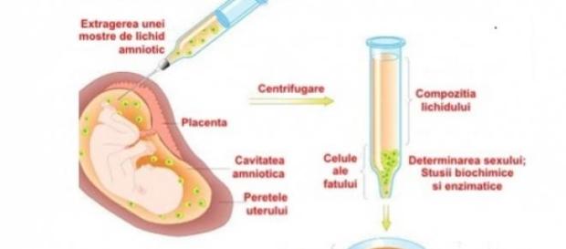 amniocenteza-metoda de procedură amniocenteza-metoda de procedură