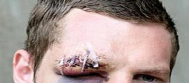 Jovem agredido pode vir a ter problemas de visão. Jovem agredido pode vir a ter problemas de visão.