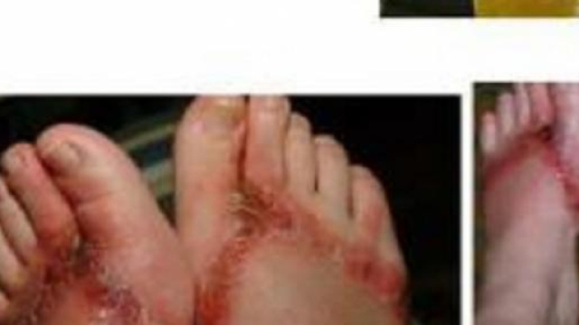 Infradito pericolose per la nostra salute