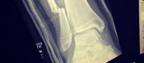 Radiografía de la pierna rota de Dave