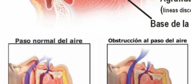 la apnea del sueño, causas la apnea del sueño, causas