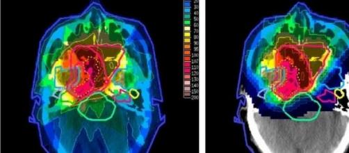 Terapia protonica, la nuova radioterapia