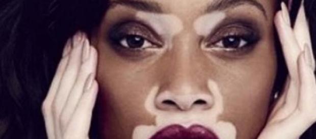 Winnie Harlow, modelo y portavoz de la enfermedad Winnie Harlow, modelo y portavoz de la enfermedad