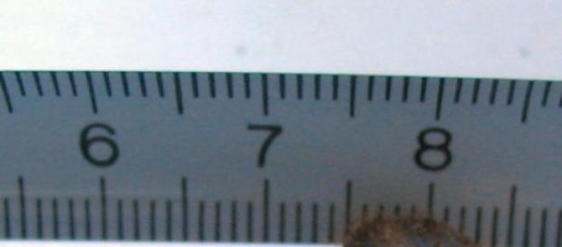 Une larve de 3 cm nichée dans l’œil Une larve de 3 cm nichée dans l’œil