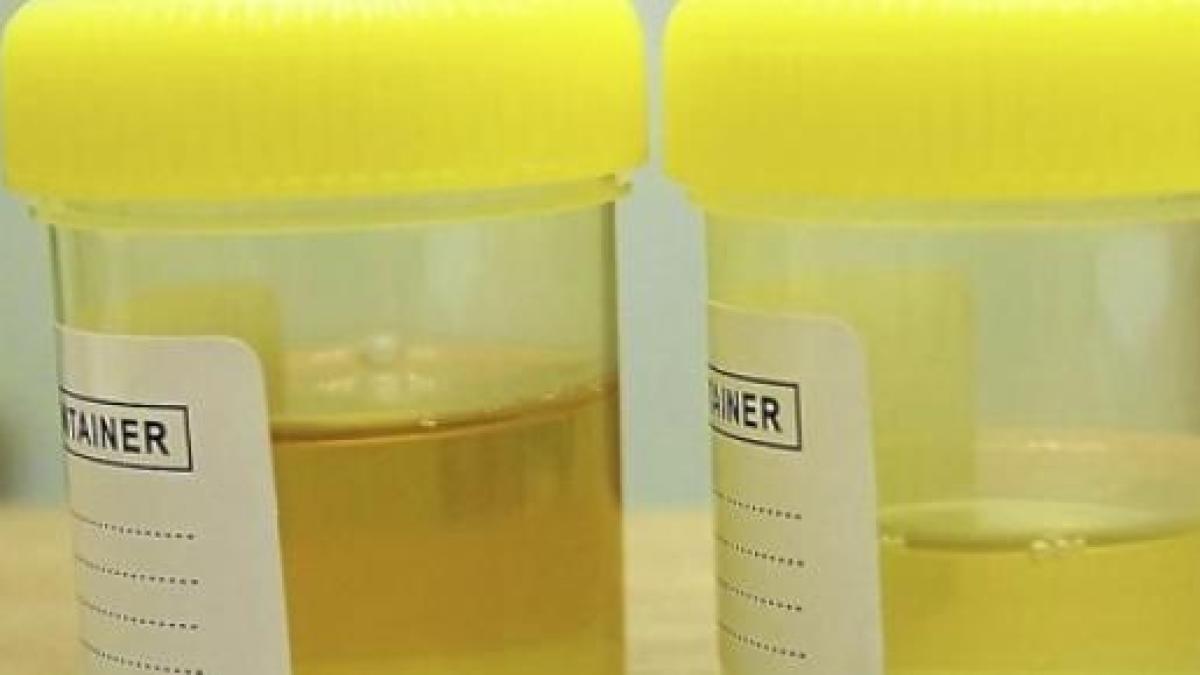 Occhio Al Colore Delle Vostre Urine Rivela Eventuali