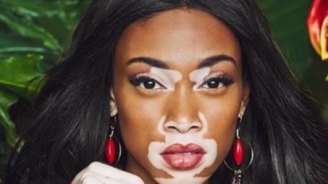 Winnie Harlow, la modella affetta dalla vitiligine