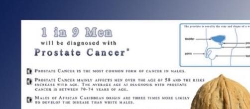 The most common cancer in men: prostate cancer
