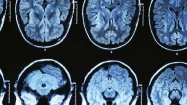 Il cervello con l'Alzheimer