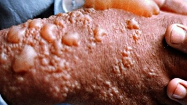 Gli effetti del gas mostarda sulla pelle