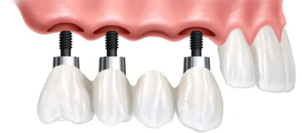 Implantes dentales y dientes sanos Implantes dentales y dientes sanos