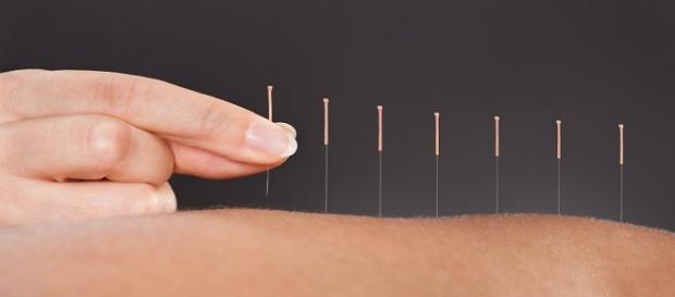 Acupuntura para emagrecer e reduzir flacidez Acupuntura para emagrecer e reduzir flacidez