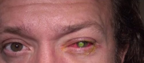 Chad Groeschen: lentillas y pérdida de visión