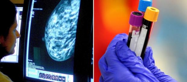 Análisis de sangre para detectar cáncer de mama Análisis de sangre para detectar cáncer de mama