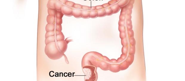 Cáncer colorrectal, nueva diana terapéutica Cáncer colorrectal, nueva diana terapéutica