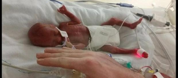 bebê de 400 g surpreende a medicina bebê de 400 g surpreende a medicina
