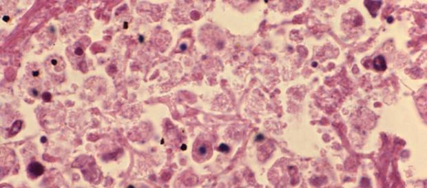 Em 2014 a legionella provocou 12 mortes Em 2014 a legionella provocou 12 mortes