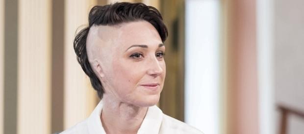Aceasta fata a ramas cu o trauma Aceasta fata a ramas cu o trauma