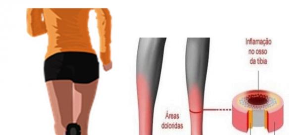 Sìndrome do estresse tibial; a canelite Sìndrome do estresse tibial; a canelite