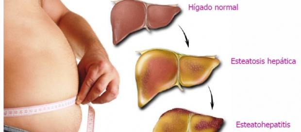 Hígado, protégelo con plantas naturales Hígado, protégelo con plantas naturales