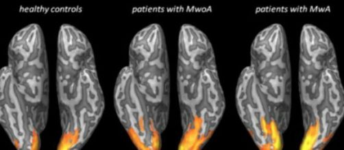 Fotografato il cervello con emicrania con aura