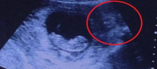 Ultra-sonografia mostra demônio vigiando um bebê Ultra-sonografia mostra demônio vigiando um bebê