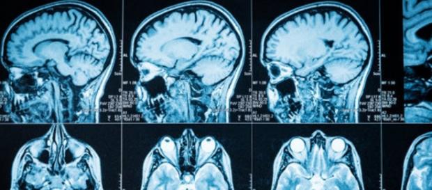 Pesquisadores utilizaram ressonância em estudo Pesquisadores utilizaram ressonância em estudo