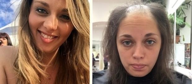 Ela ficou totalmente careca após ter doença rara que causa compulsão por arrancar os fios. Ela ficou totalmente careca após ter doença rara que causa compulsão por arrancar os fios.