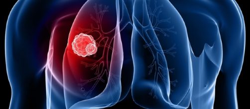 Cancro ai polmoni, scoperto il nuovo farmaco miracoloso in grado di discioglierlo