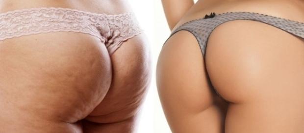 Conheça as mentiras sobre as famosas celulites Conheça as mentiras sobre as famosas celulites