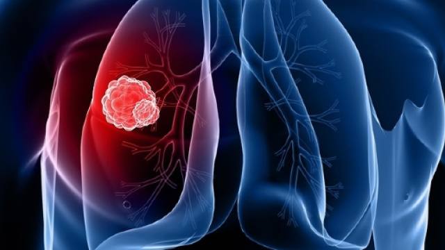 Cancro ai polmoni, scoperto il nuovo farmaco miracoloso in grado di discioglierlo